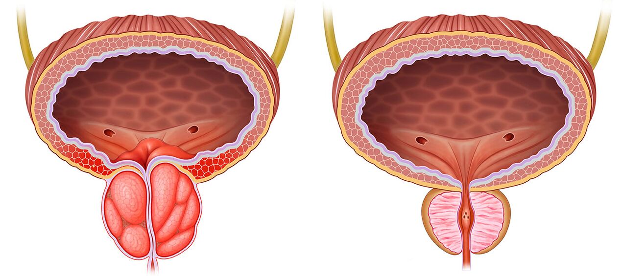 Prostata inflamada y saludable después de usar cápsulas Predstonorm