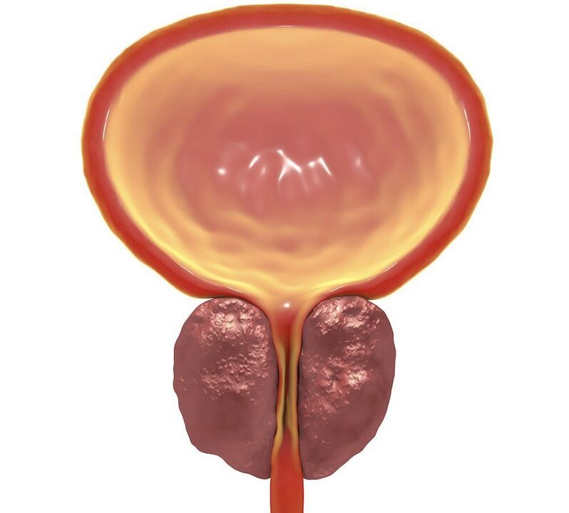 inflamación de la prostatitis crónica