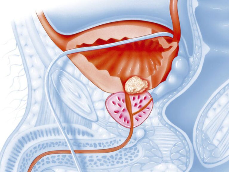 síntomas de prostatitis crónica