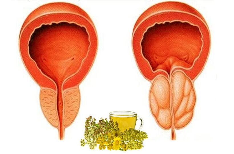Prostato sano y dolorido