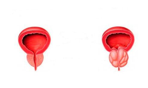 próstata sana e inflamada con prostatitis